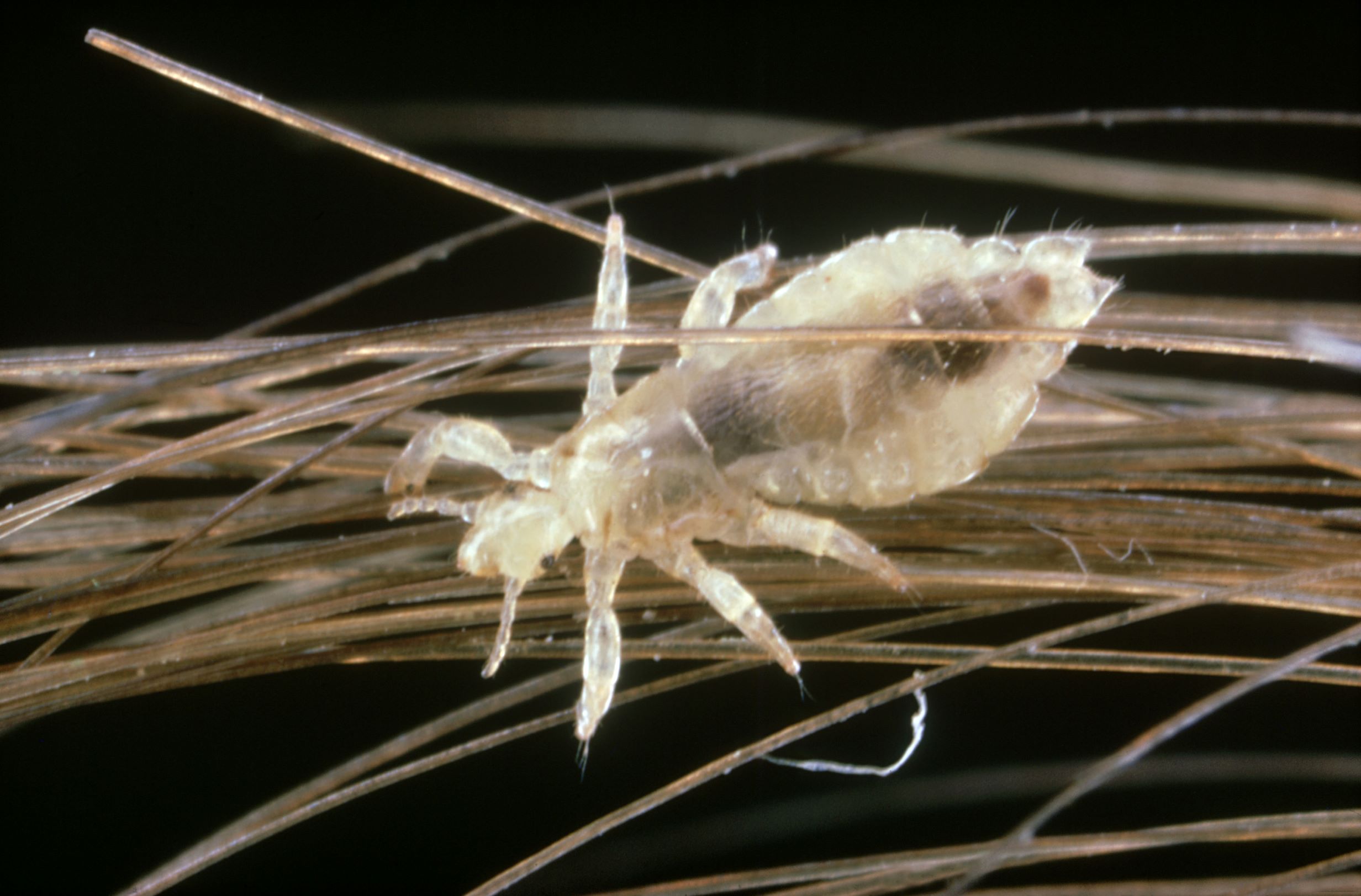 Body Lice Infestation Causes Symptoms  Diagnosis